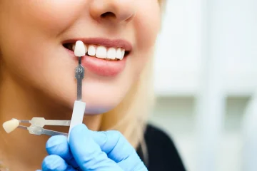 Veneers in Sydney
