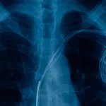 Pacemakers Work