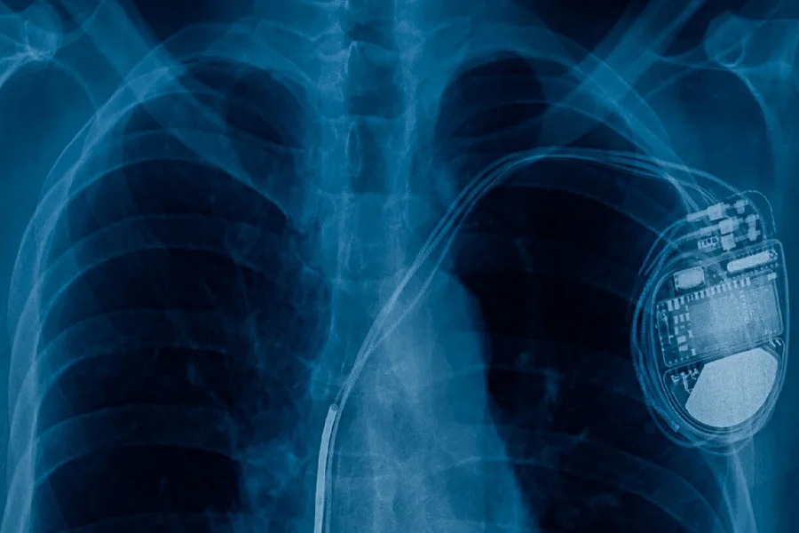 Pacemakers Work