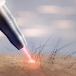 Laser Hair Removal
