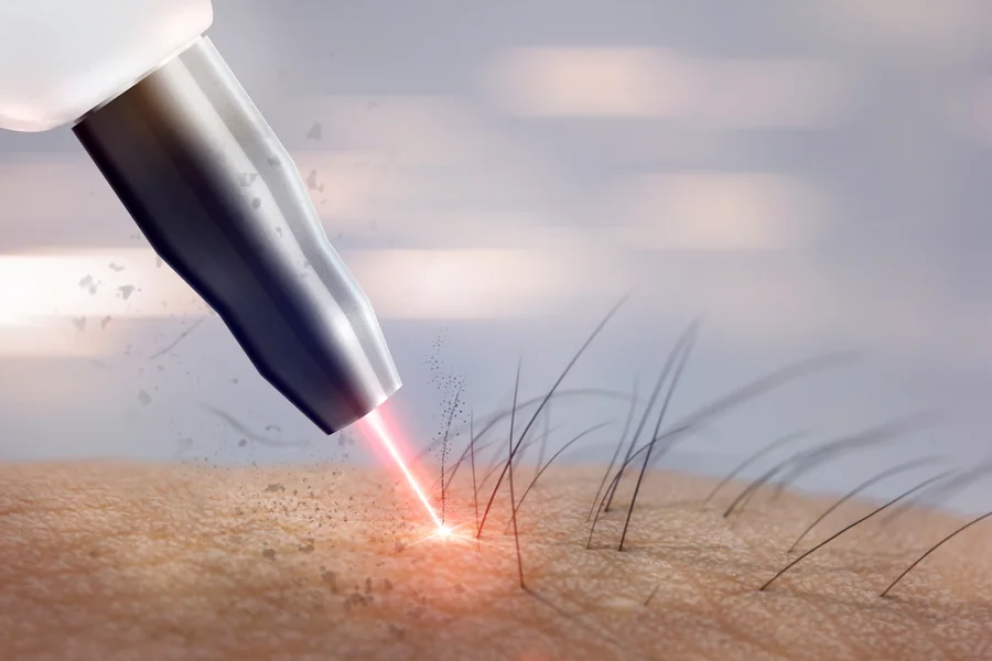 Laser Hair Removal