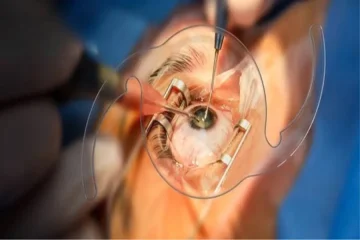 Cataract Surgery