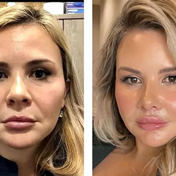 Facelift Really
