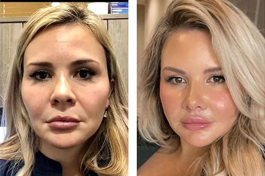 Facelift Really